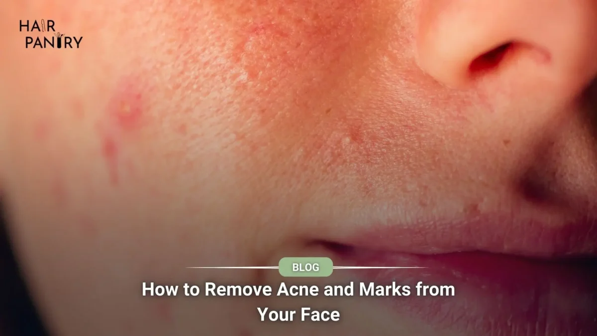 How to Remove Acne and Marks from Your Face